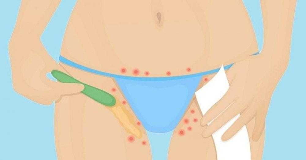 Como evitar pelos encravados na depilação com lâmina d
