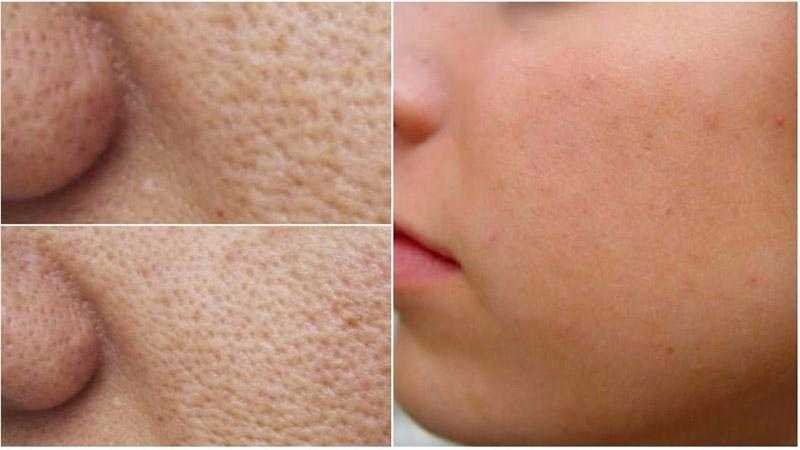 Como fazer os poros desaparecerem com apenas alguns ingredientes