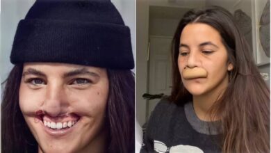 Modelo que perdeu lábio superior após ataque de pitbull mostra resultado de cirurgia reparadora: ‘Muito grata’