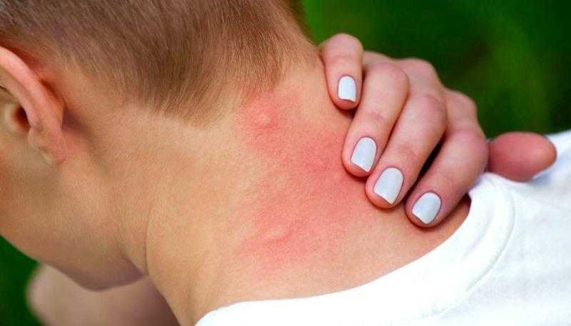 Por que os mosquitos picam mais umas pessoas que outras