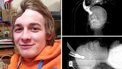 Jovem fica com cabeça deformada após receber marteladas de amigo que era contra sua homossexualidade