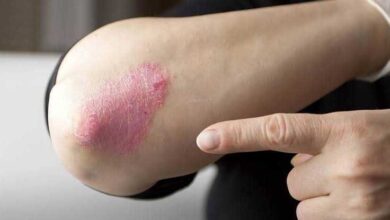 7 dicas de cuidados para pele com psoríase