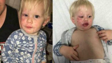 Bebê tem grave reação alérgica após usar roupas novas sem lavar