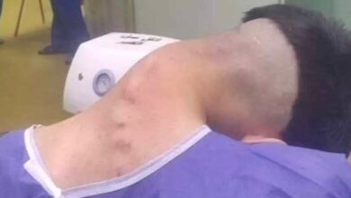 homem sofre de sindrome rara de queda da cabeca causada por vicio 1 e1747233775298