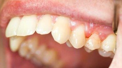 Remédios caseiros para a inflamação das gengivas
