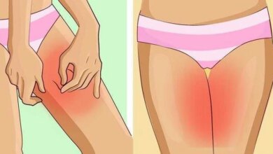 Como evitar irritações nas coxas durante o verão tg